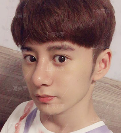 李保楷+上海美萊自體軟骨隆鼻手術(shù)