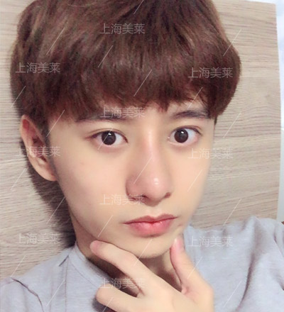 李?？?美萊自體軟骨隆鼻