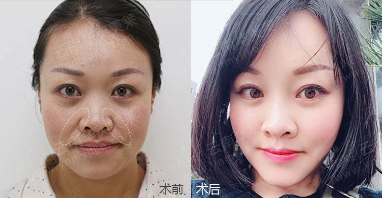 注射玻尿酸除皺手術后，需要注意哪些事項？