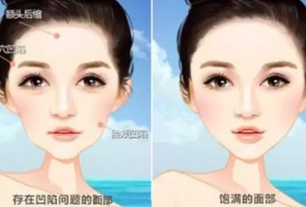 面部做脂肪填充能維持多長時(shí)間
