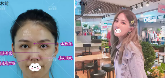 重慶美萊整形美容醫(yī)院做鼻子好嗎？單磊真實(shí)案例分享