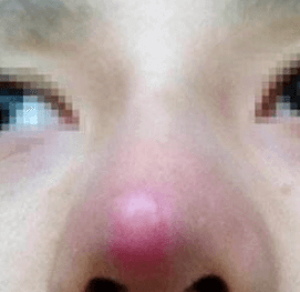 武漢打玻尿酸隆鼻會不會留下后遺癥？