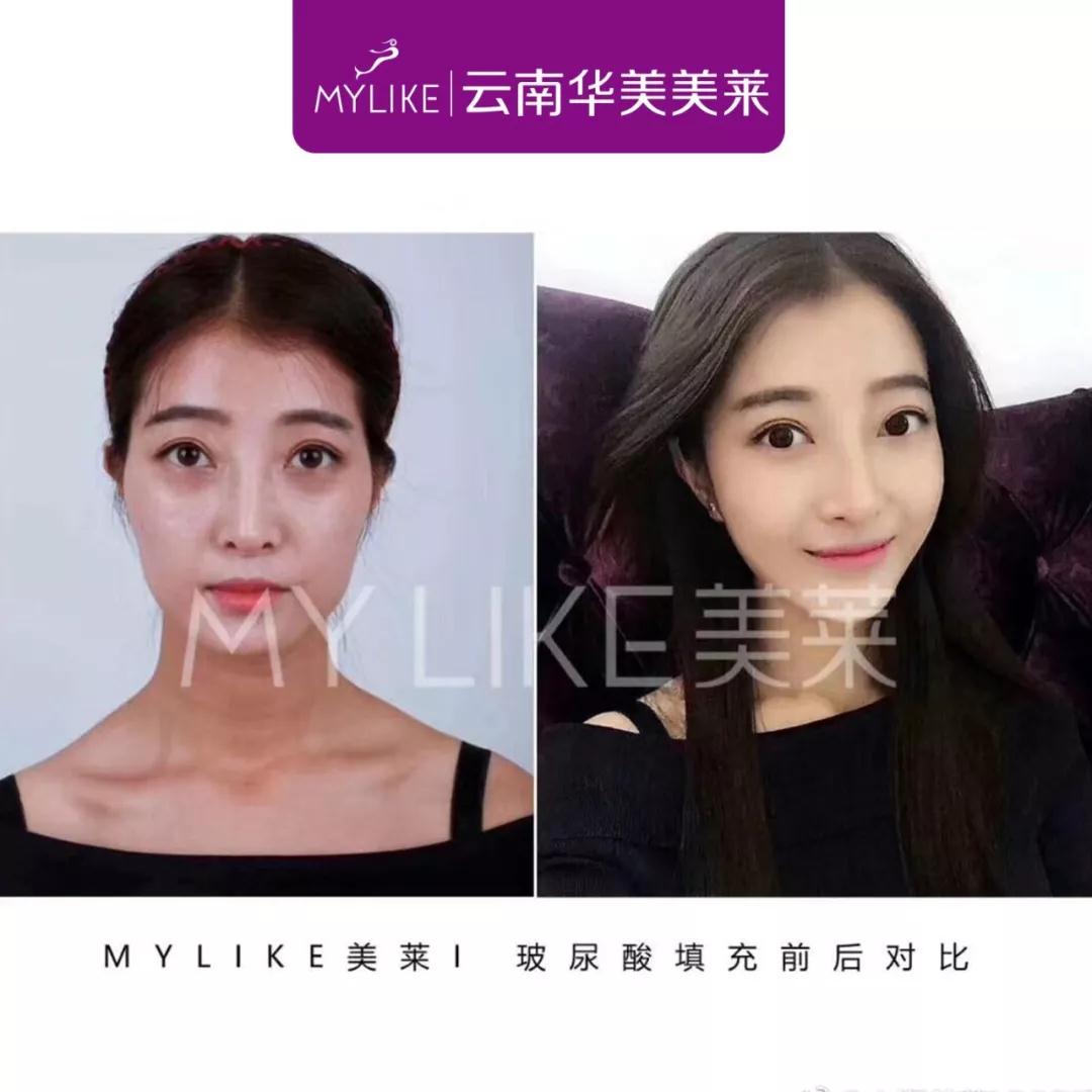 選擇玻尿酸填充面部有副作用嗎，會不會凹凸不平?
