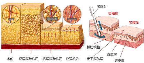 沈陽做大腿吸脂對(duì)身體會(huì)不會(huì)有影響