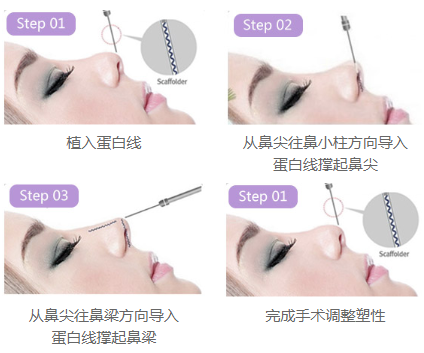 昆明*雕隆鼻大約多少錢(qián)