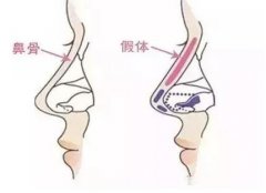 重慶假體隆鼻哪家醫(yī)院好?秀氣的鼻子更配你漂亮的臉蛋！