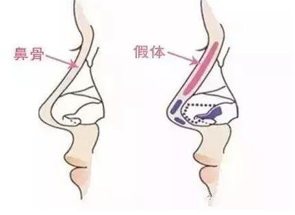 重慶假體隆鼻哪家醫(yī)院好?秀氣的鼻子更配你漂亮的臉蛋！