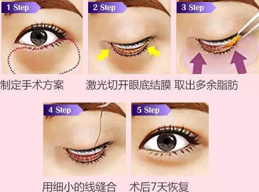 <a href='/sy/' target='_blank'><u>沈陽美萊</u></a>講解眼袋到底有多嚇人，你敢看嗎？