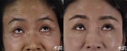 2018年過得很開心的你，皺紋有沒有增多？