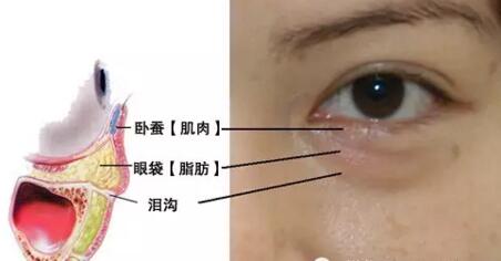 北京切除眼袋術會出現(xiàn)疤痕嗎