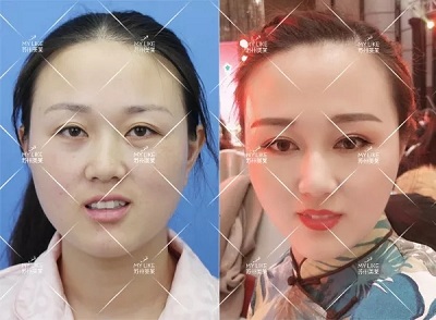 有些眼睛雙眼皮拯救不了，就來<a href='/suz/' target='_blank'><u>蘇州美萊</u></a>做眼綜合手術(shù)！