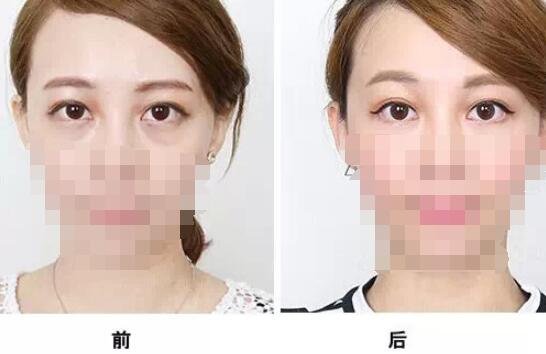 通過手術(shù)祛眼袋多久看都效果?會有疤痕嗎？