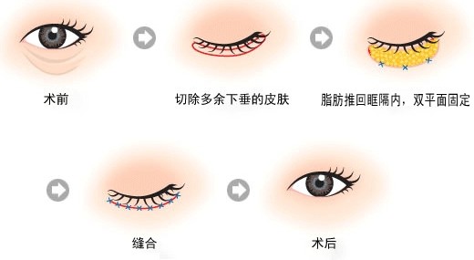 通過手術(shù)祛眼袋會有疤痕嗎？