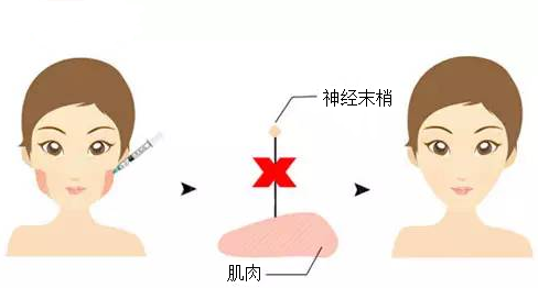 成都瘦臉的效果能夠維持多長時(shí)間