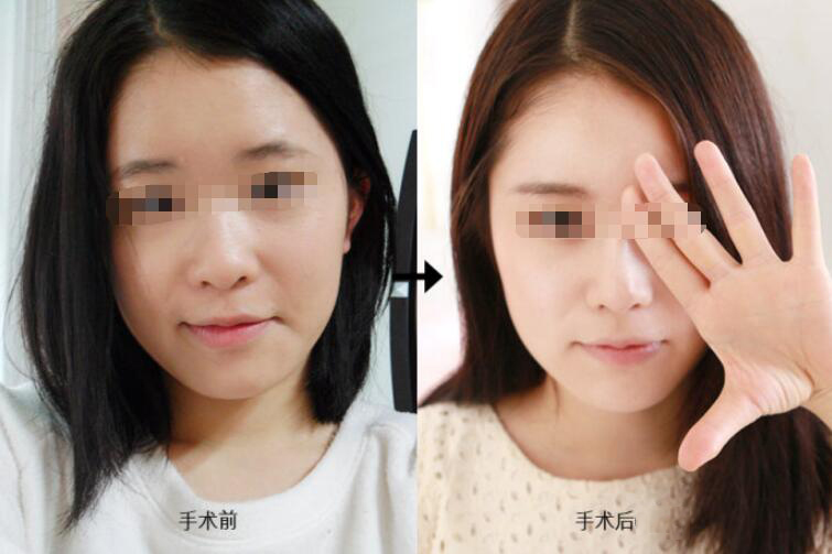 深圳假體隆鼻失敗修復(fù)多少錢？