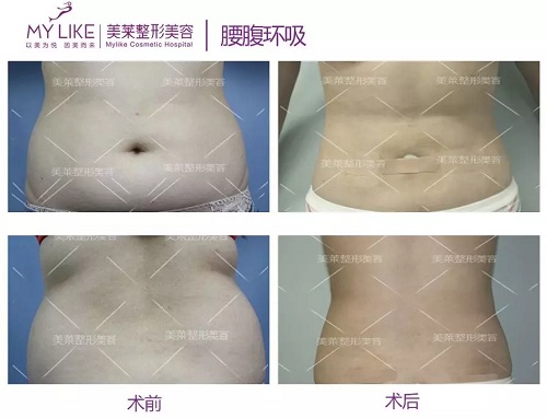 美萊醫(yī)院：據(jù)說男人都愛這種“沙漏身材”？！