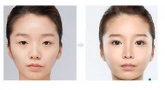 天津做上瞼下垂矯正的價(jià)格是多少？