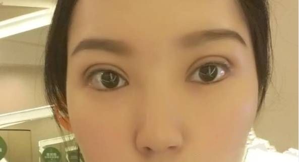 深圳做雙眼皮修是不是很貴？
