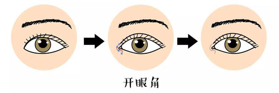 開(kāi)眼角