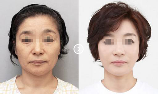 深圳激光除皺價(jià)格多少錢？能?徹底的去除嗎?