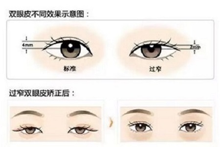 雙眼皮修復術(shù)后我們要如何護理