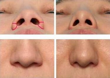 鼻孔大怎么辦？能做手術(shù)縮小嗎？