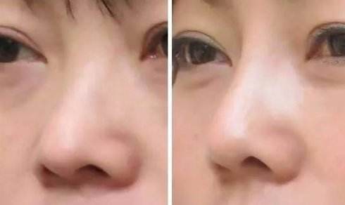隆鼻后修復(fù)手術(shù)恢復(fù)時(shí)間會(huì)更長(zhǎng)嗎？
