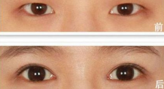 上眼瞼下垂怎么辦？