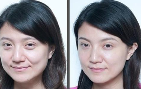 上眼瞼下垂怎么辦？