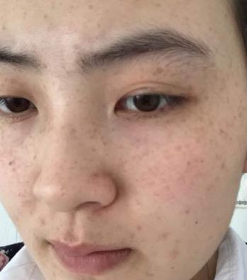 臉上長(zhǎng)斑的原因是什么？