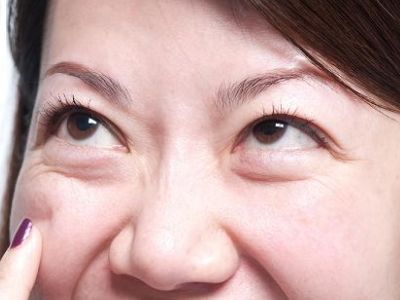 30歲就有眼袋怎么辦？
