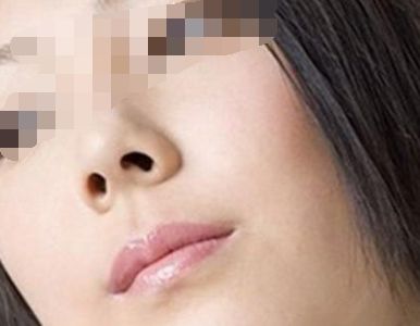 矯正鼻孔大的手術(shù)會(huì)留疤嗎？