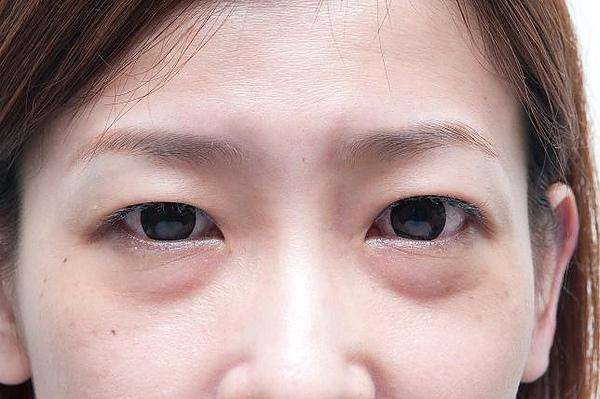 怎么消除眼袋這個煩人精？
