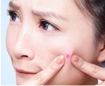 滿臉痘印怎么辦？