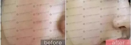 水光后為什么皮膚反而會(huì)變黑？