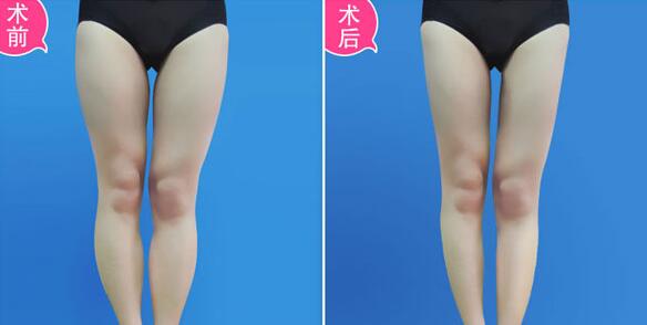 吸脂價(jià)格是多少？