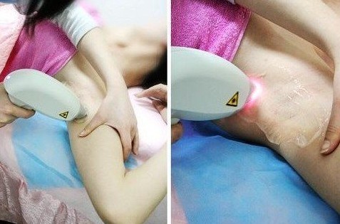 激光脫毛疼嗎？