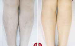 性脫毛對(duì)身體健康有危害嗎？
