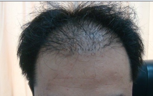 植發(fā)的術后護理要注意什么？