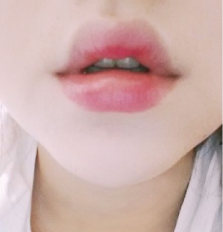 玻尿酸豐唇的效果怎么樣？