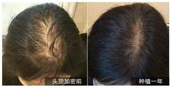 頭發(fā)種植后怎么護(hù)理？