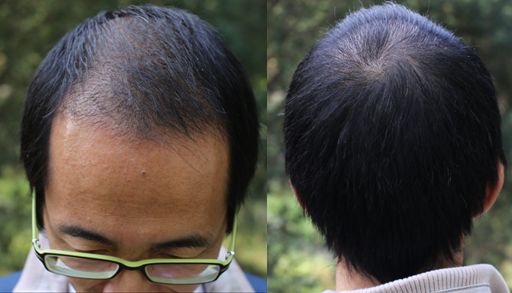 頭發(fā)種植后怎么護(hù)理？