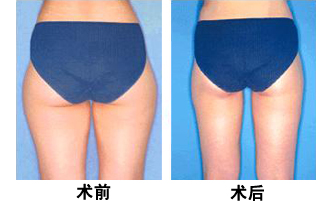 南京臀部吸脂減肥價格要多少錢？