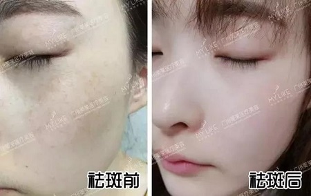 1次祛斑，就有無暇、透亮的大白皮？
