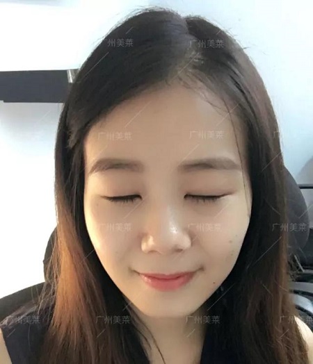 割雙眼皮，還開了眼角...