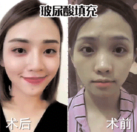 面對法令紋，玻尿酸or脂肪填充誰才是救命大佬？