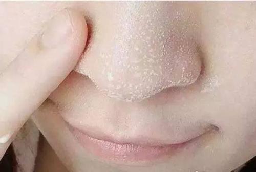深圳做鼻頭整形要多少錢？