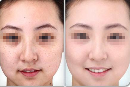 激光去雀斑都有什么優(yōu)勢(shì)呢？