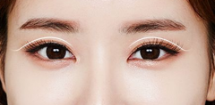 常州割雙眼皮手術(shù)后多久消腫呢？