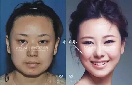 這四種臉型打玻尿酸+瘦臉，立刻變專業(yè)小V臉